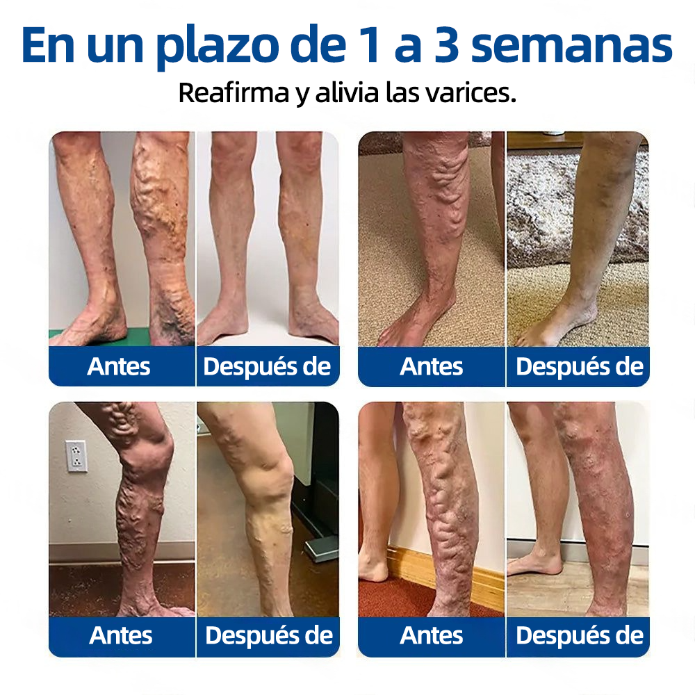 🇲🇽👨‍⚕️👍✅Healrize® Parche Microneedle VeinTarget🎖️Alivio Instantáneo, Resultados a Largo Plazo 🎖️