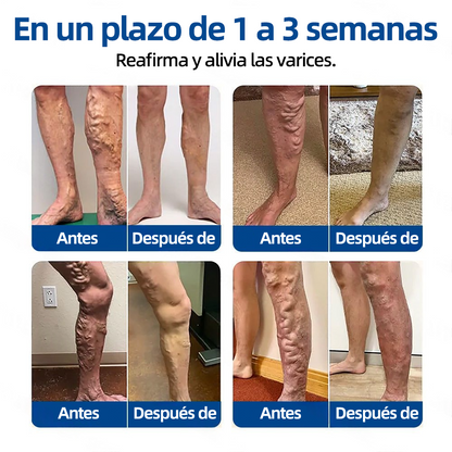 🇲🇽👨‍⚕️👍✅Healrize® Parche Microneedle VeinTarget🎖️Alivio Instantáneo, Resultados a Largo Plazo 🎖️